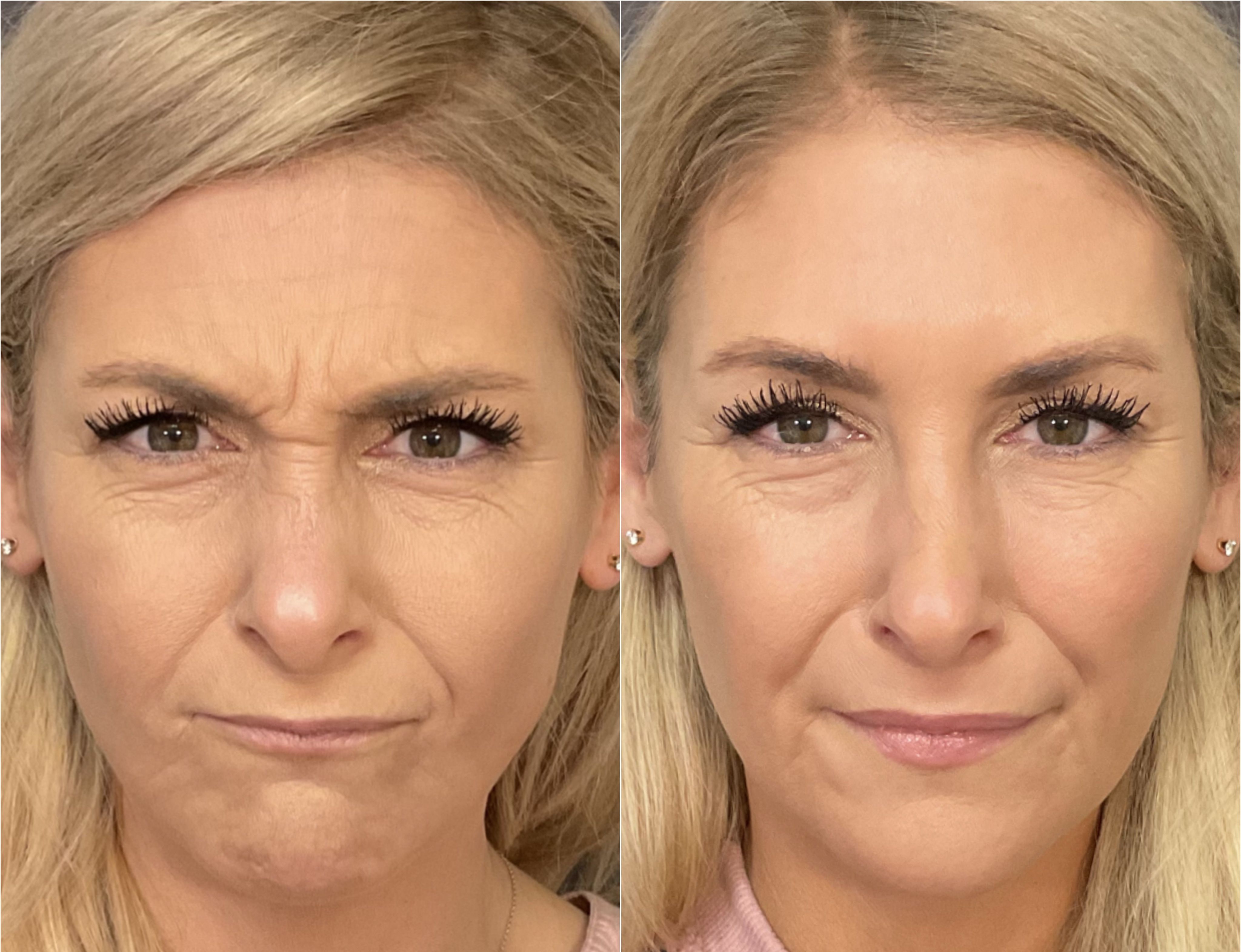 botox santa barbara results driven