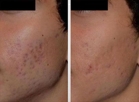 picosure santa barbara