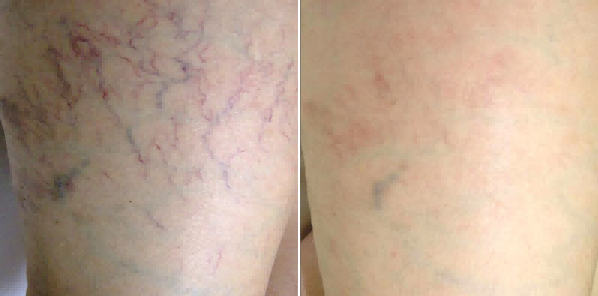 laser vein removal santa barbara before after
