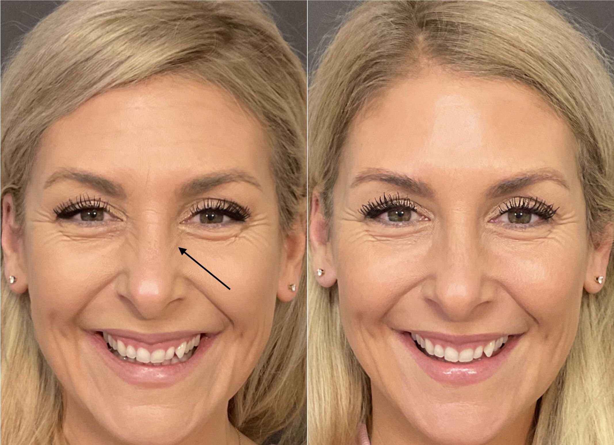 botox santa barbara before after