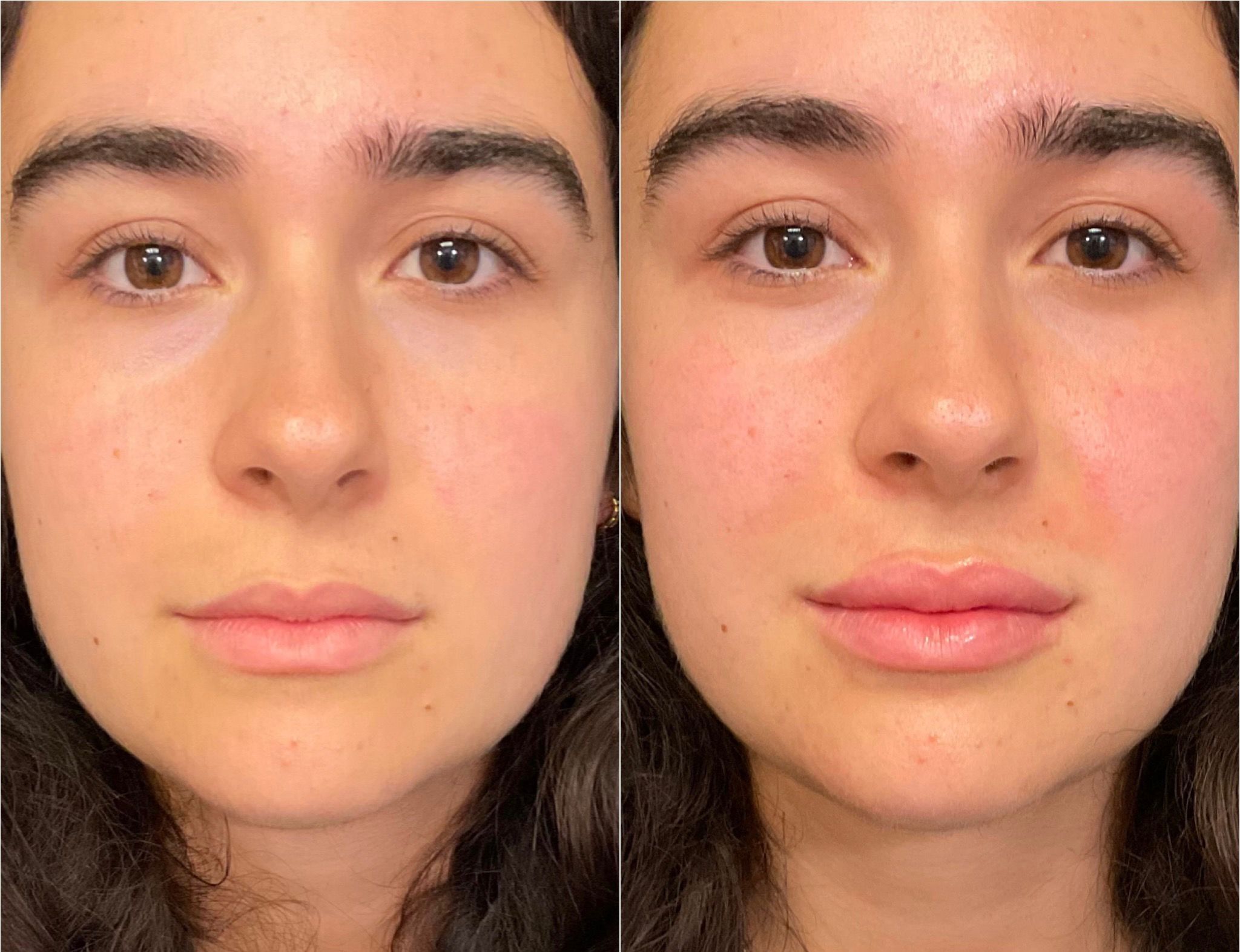 lip filler santa barbara