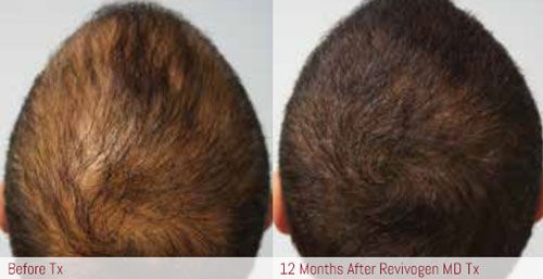 hair loss santa barbara