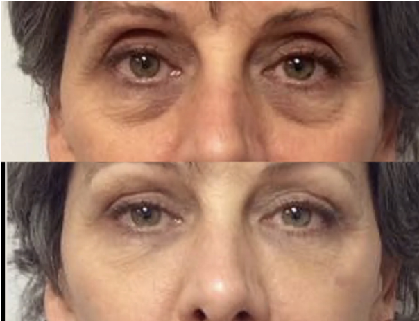 under eye filler santa barbara real patient