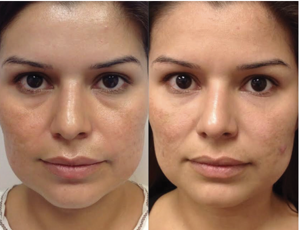 under eye filler santa barbara before after