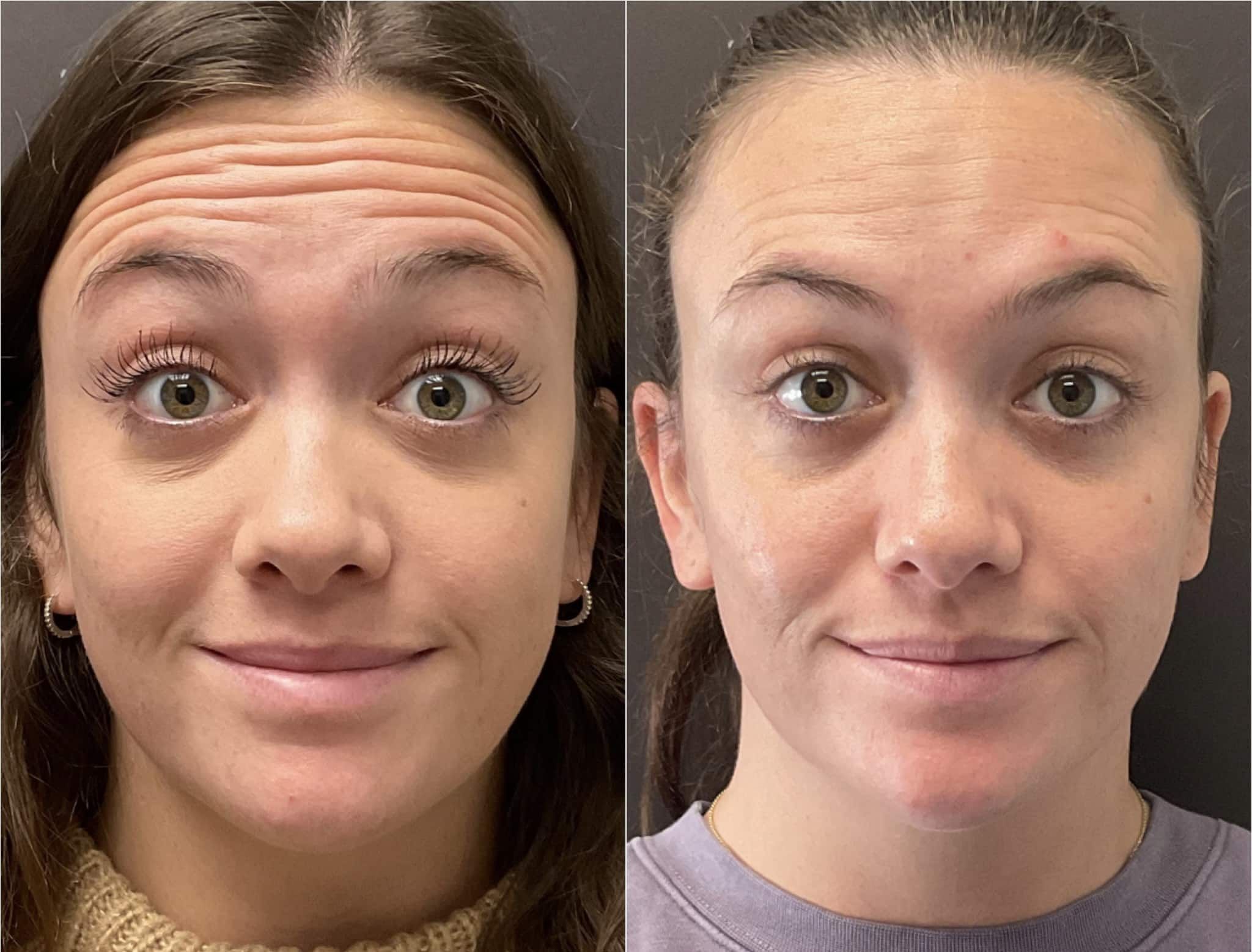 Botox In Santa Barbara