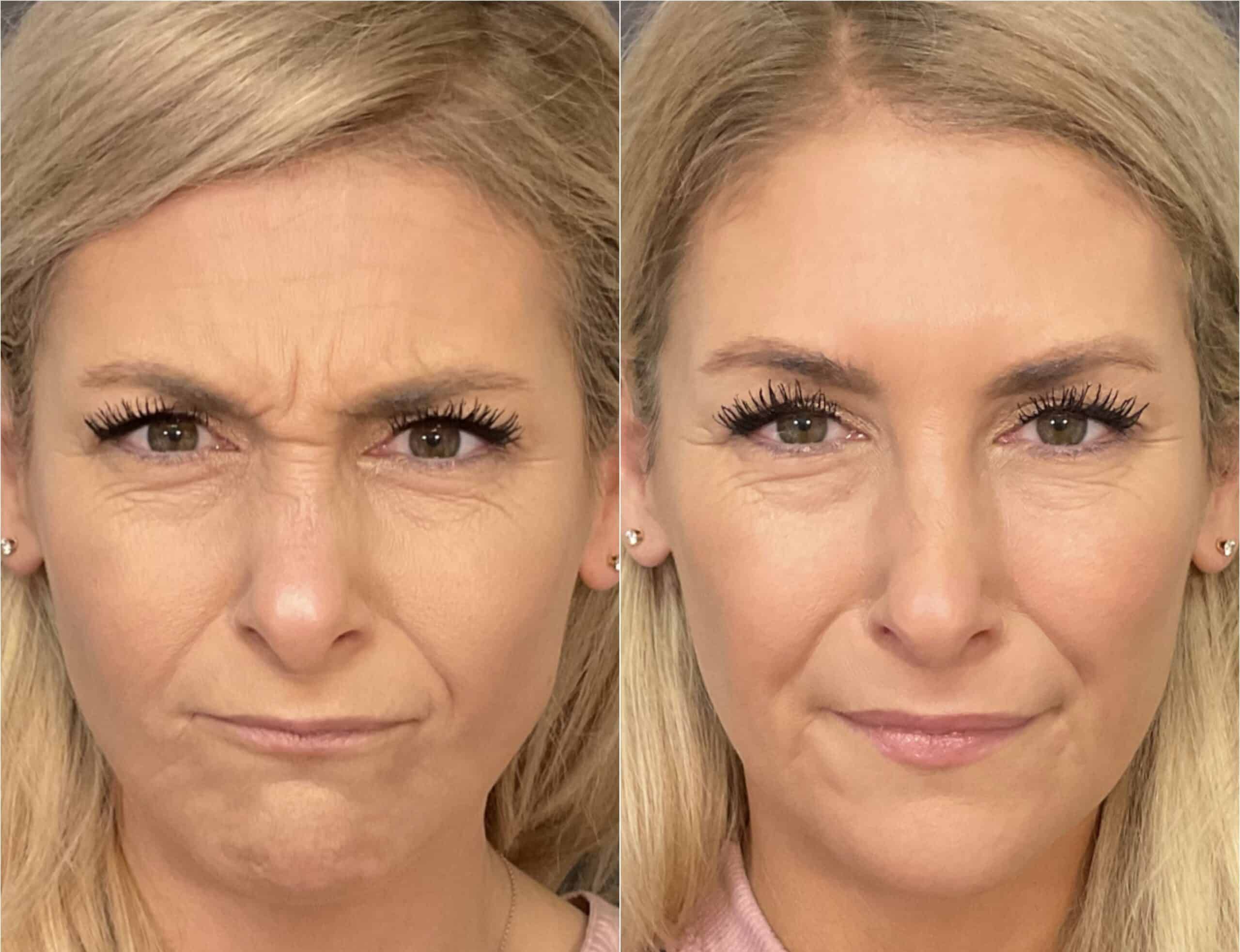 Botox In Santa Barbara