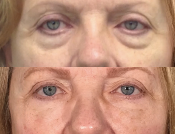 under eye filler santa barbara results