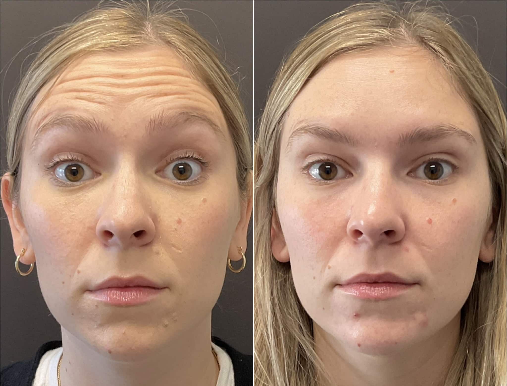Botox In Santa Barbara