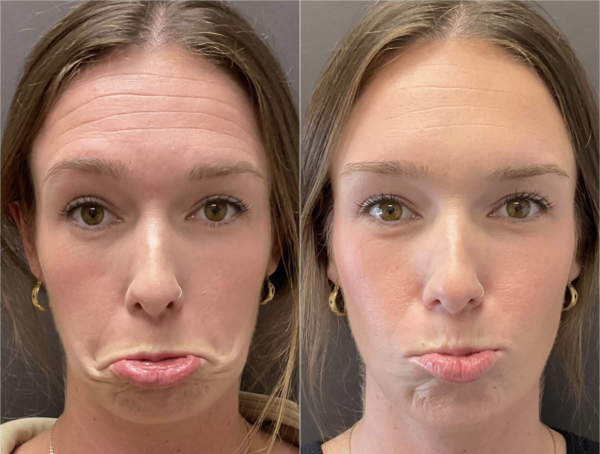 Botox In Santa Barbara