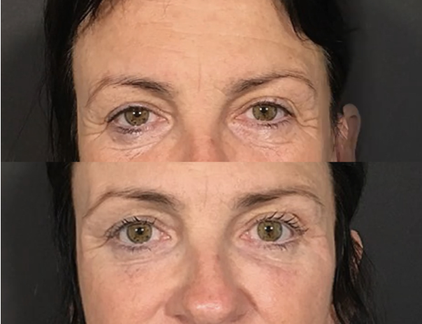 under eye filler santa barbara improvement