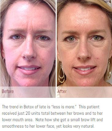 Botox and Xeomin Santa Barbara