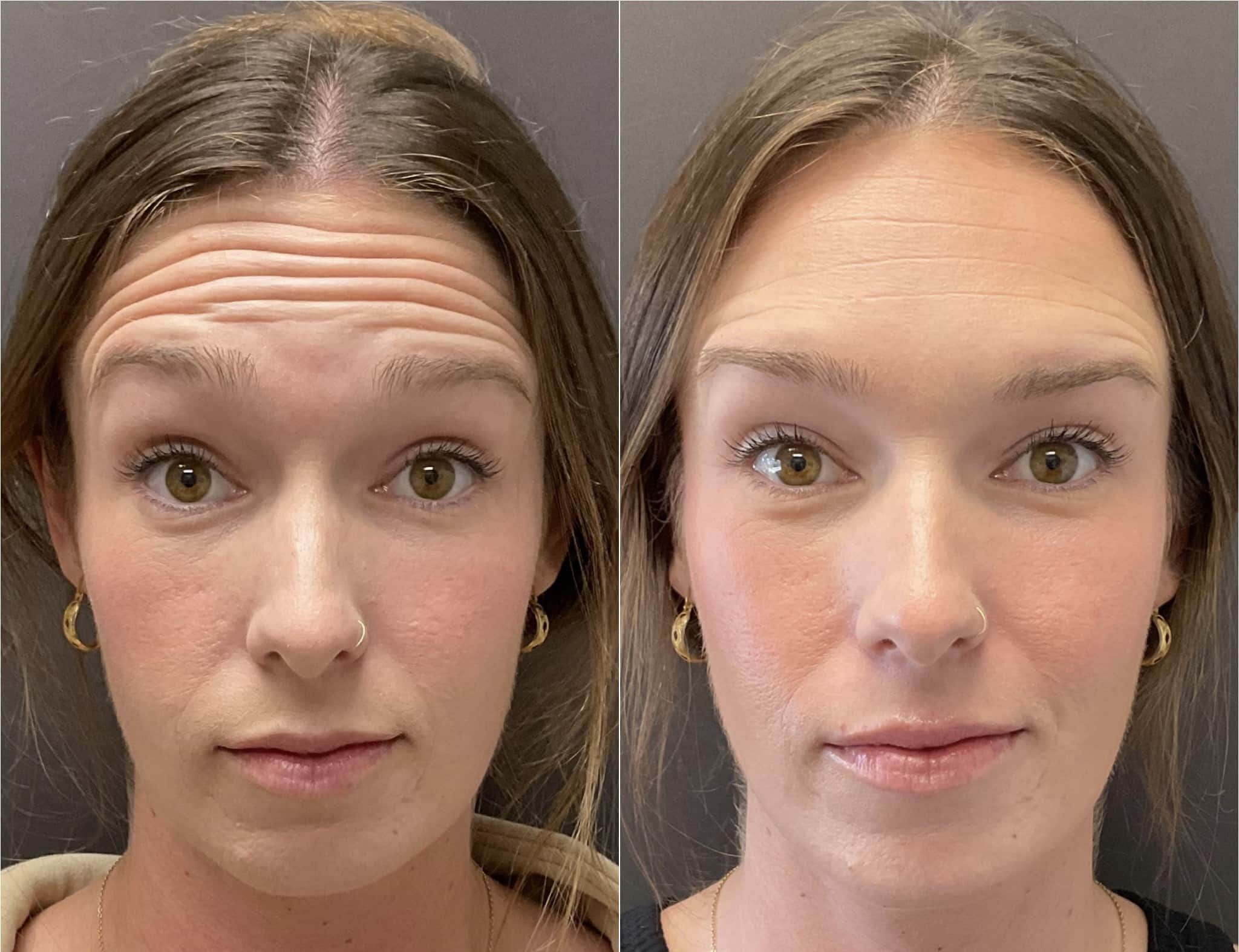 Botox In Santa Barbara