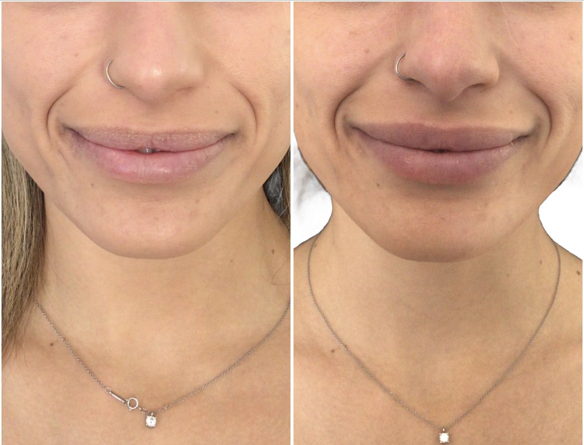 lip filler santa barbara transformation