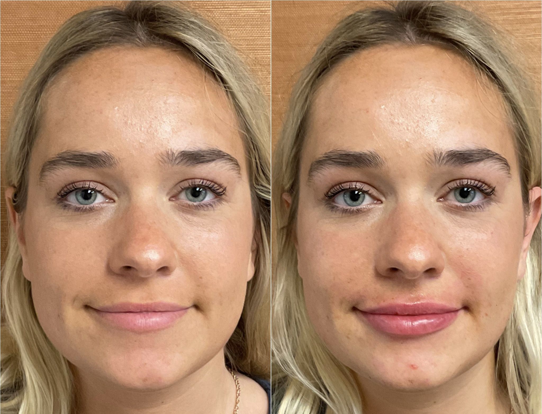 lip filler santa barbara real results