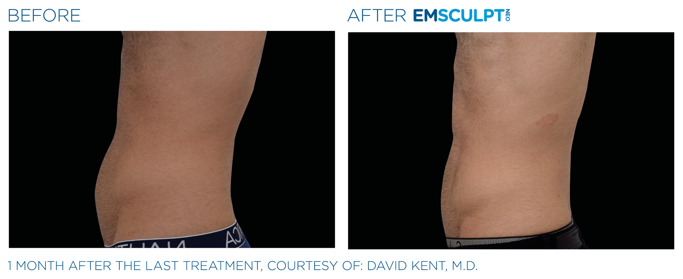 emsculpt neo santa barbara