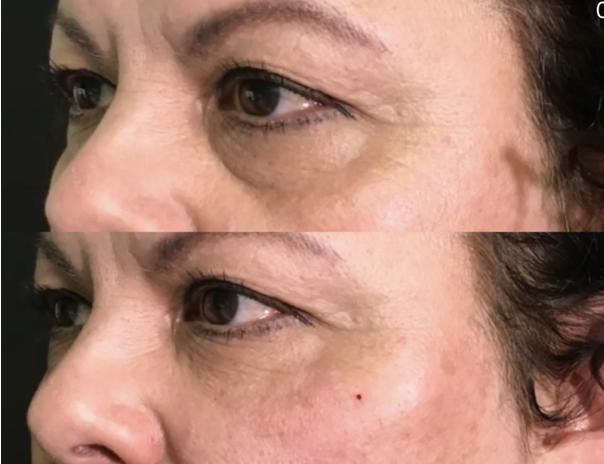 under eye filler santa barbara eliminate dark circles