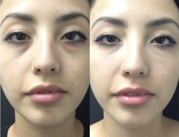 under eye filler santa barbara