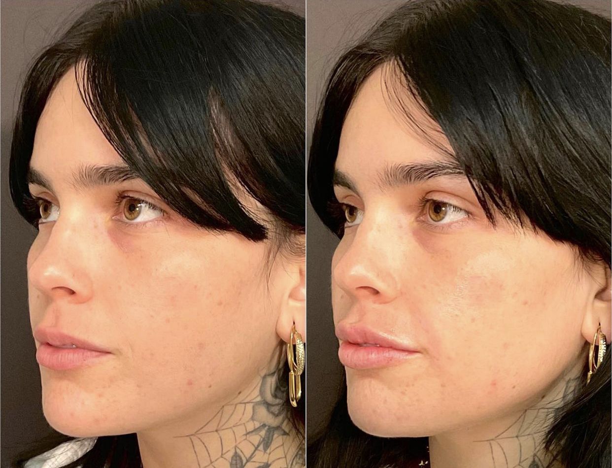 Subtle Lip Filler Santa Barbara