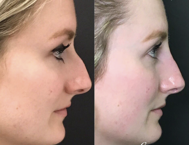 nonsurgical rhinoplasty santa barbara results