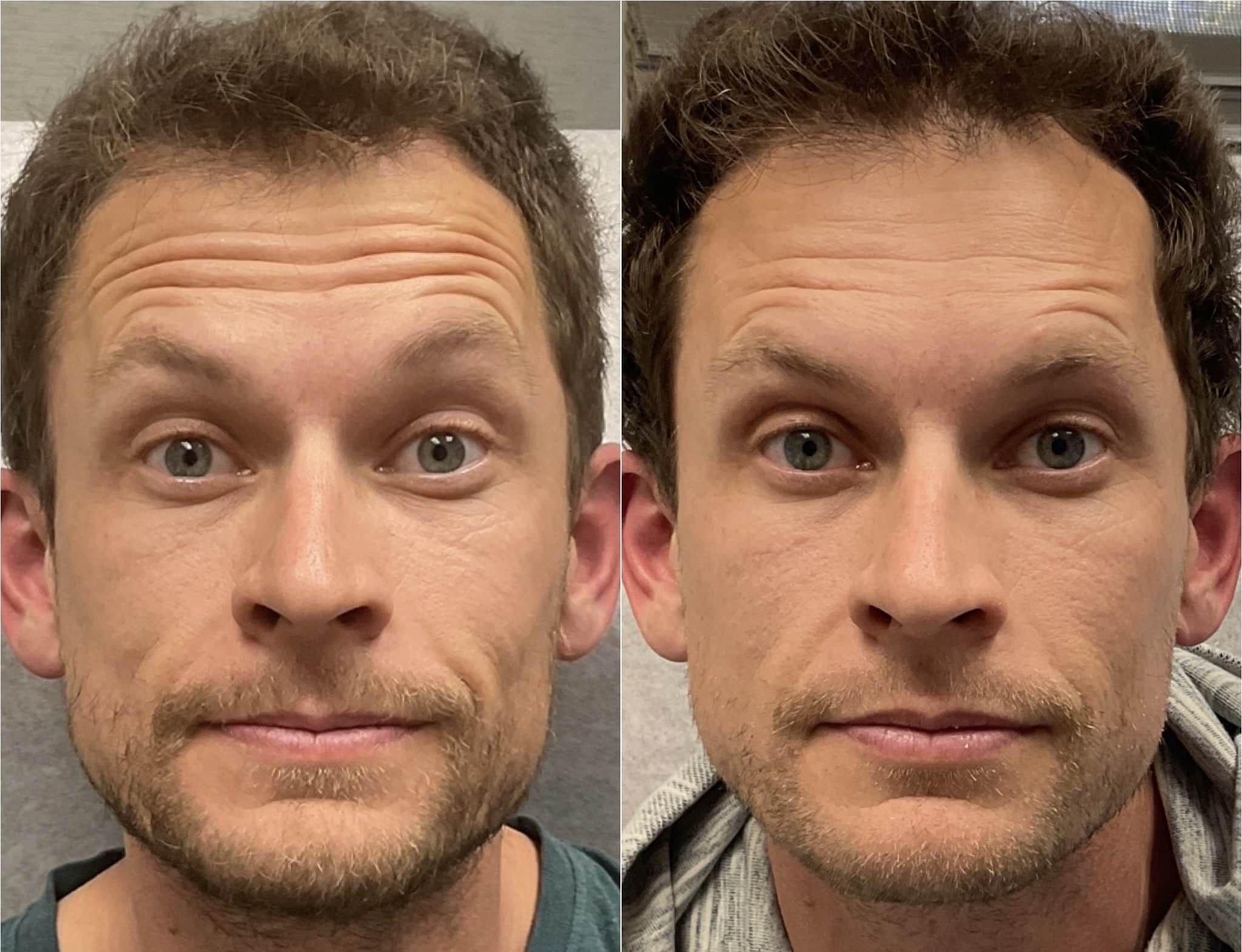Botox In Santa Barbara
