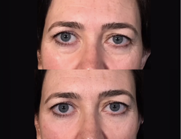 under eye filler santa barbara patient results
