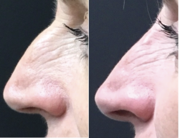 nonsurgicsl rhinoplasty