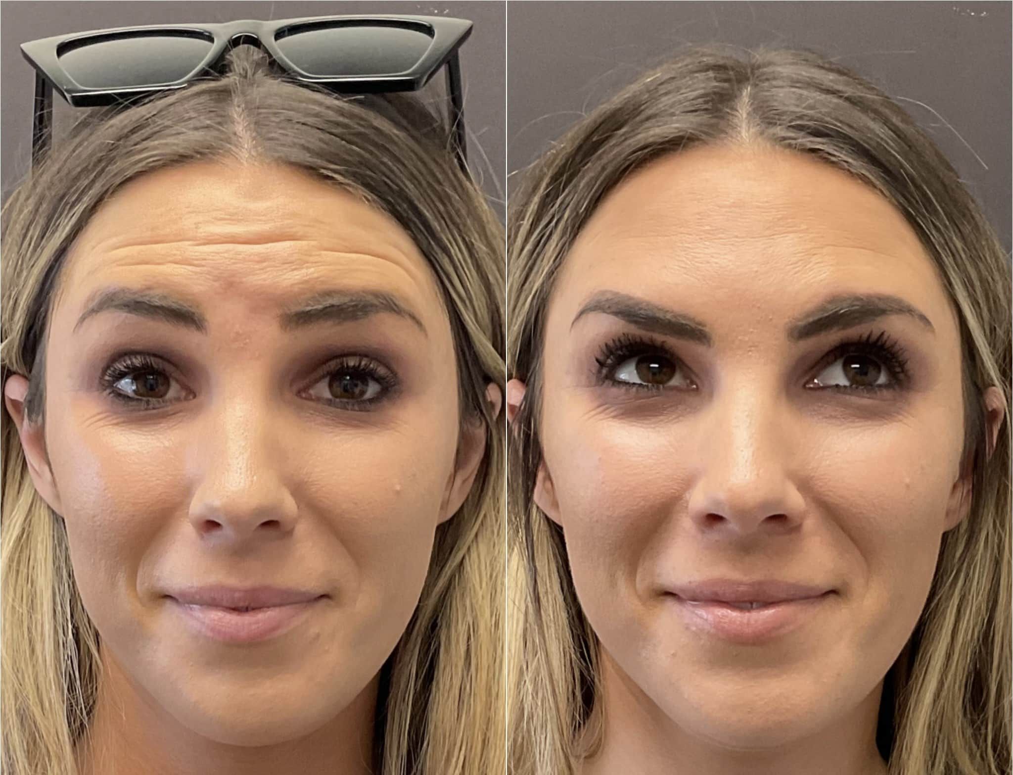 Botox In Santa Barbara