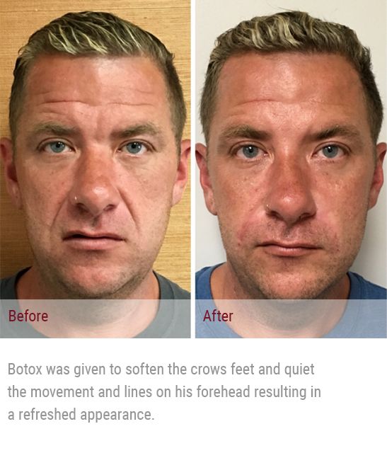 Botox and Xeomin Santa Barbara