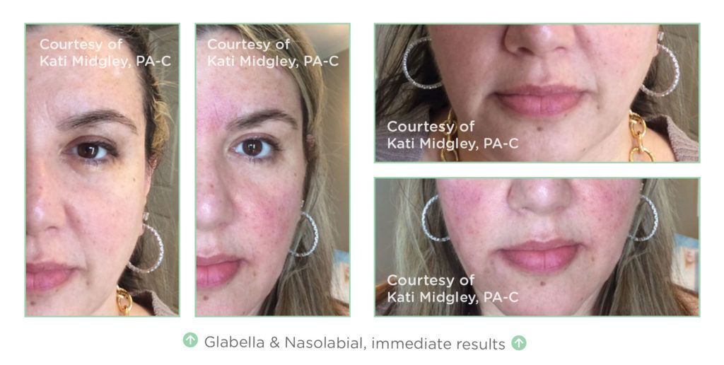 wrinkle treatments santa barbara