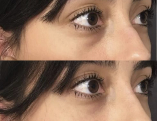 under eye filler santa barbara transformation