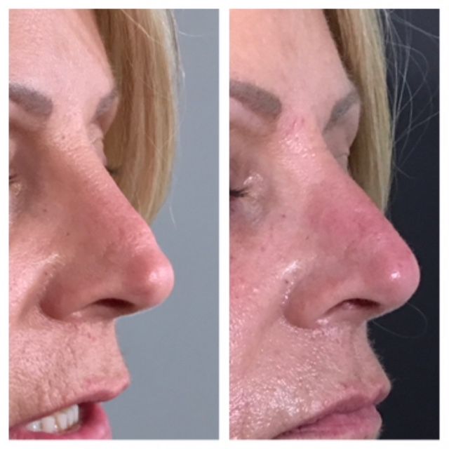 volumizing fillers santa barbara