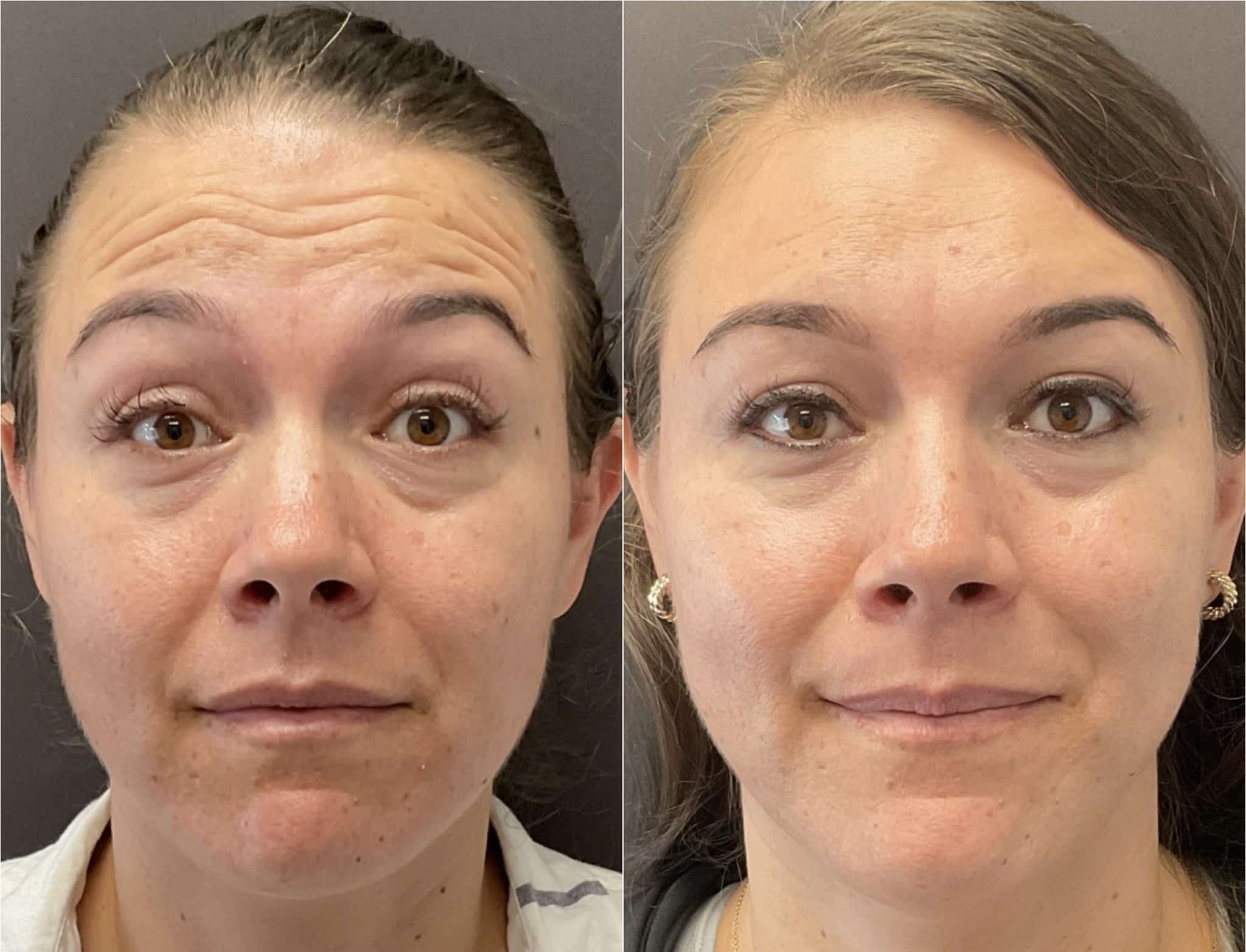 Botox In Santa Barbara