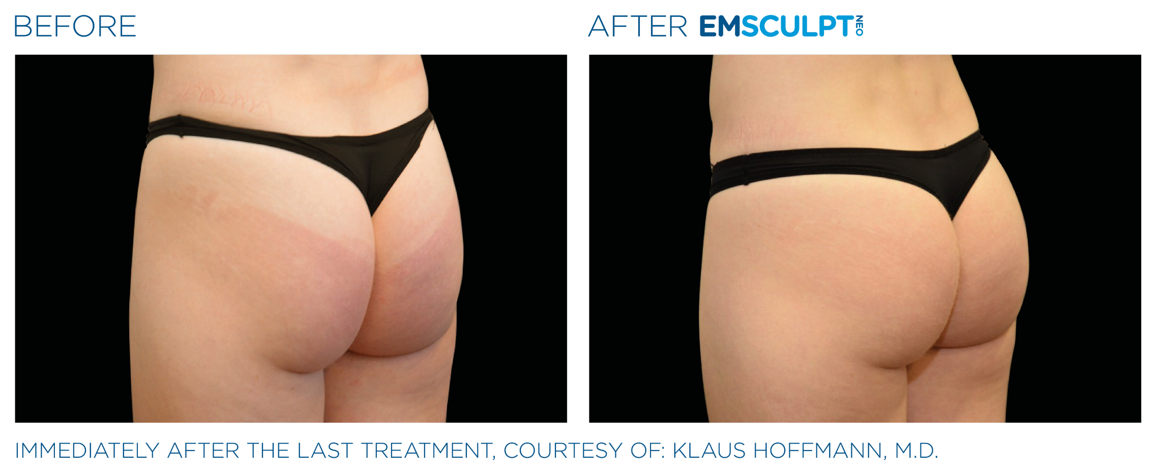 emsculpt neo santa barbara