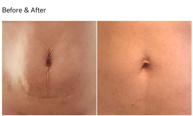 skin tightening cellulite santa barbara