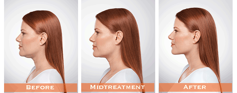 kybella santa barbara