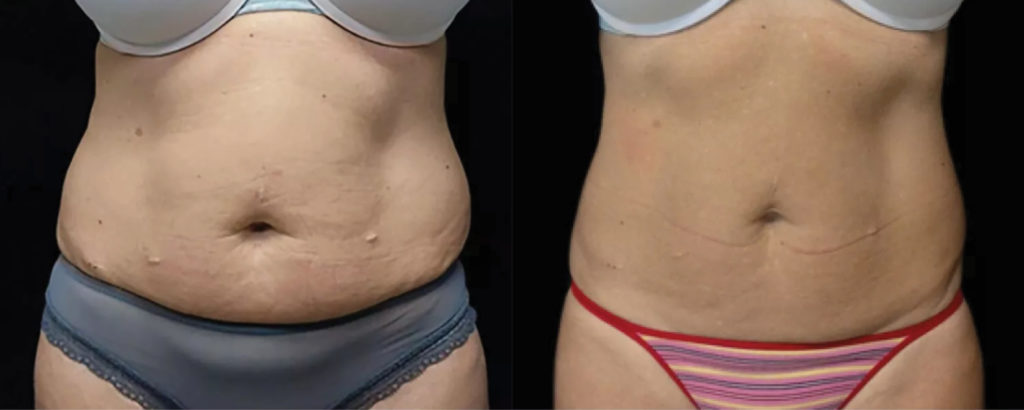 emsculpt neo results
