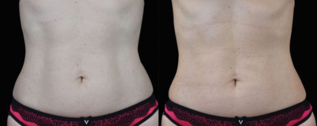 emsculpt results