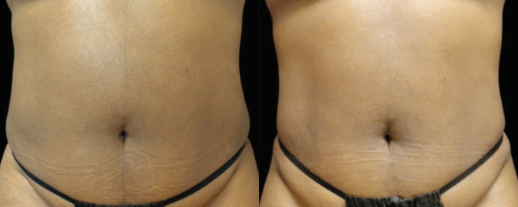 tempsure results