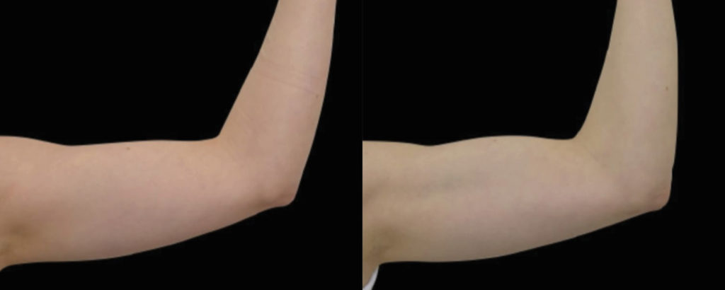 emsculpt Neo before and after