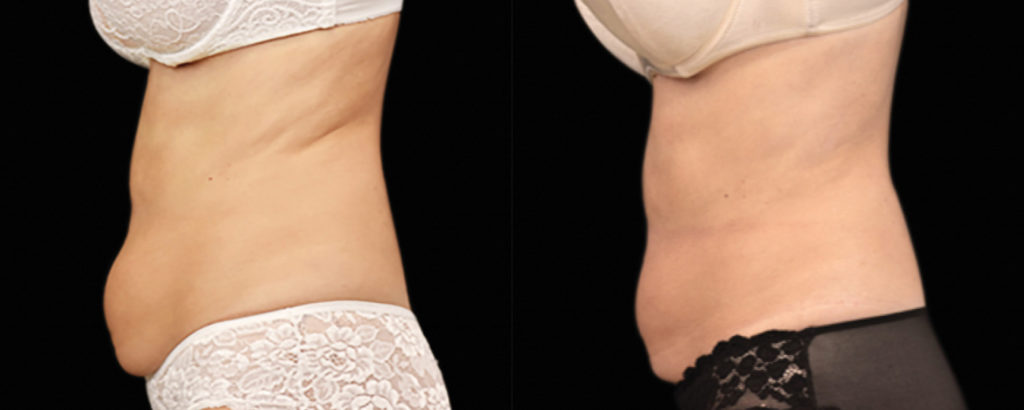 emsculpt before and after