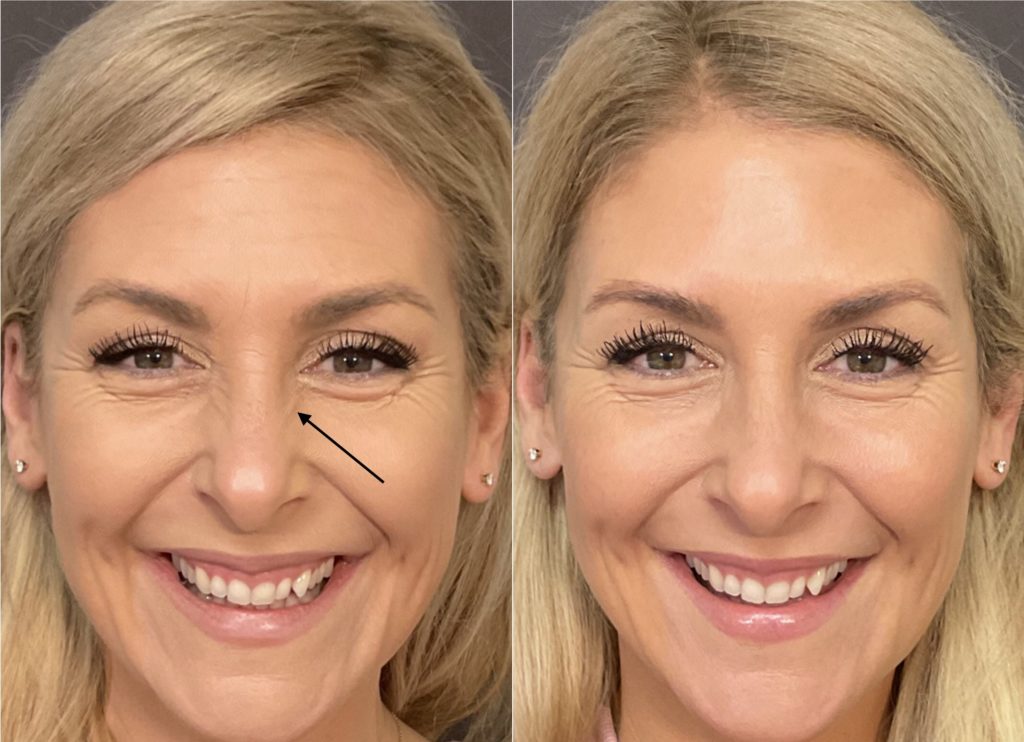 botox Santa Barbara results driven