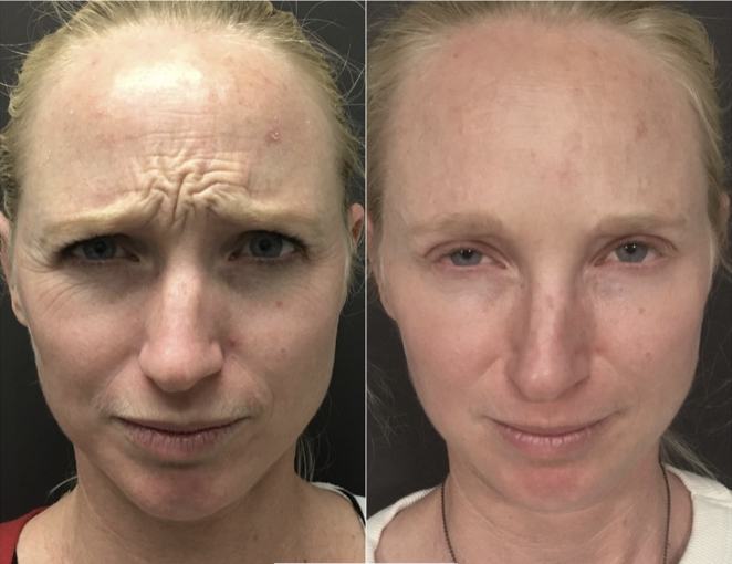 before and after botox Santa Barbara
