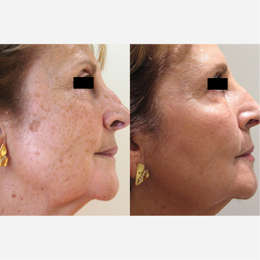 Age Spots & Sun Damage