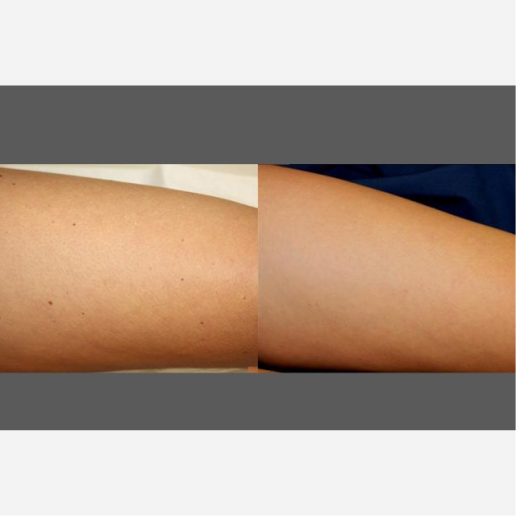 Age Spots & Sun Damage