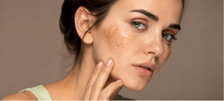 Age Spots & Sun Damage
