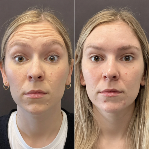 Botox Treatment