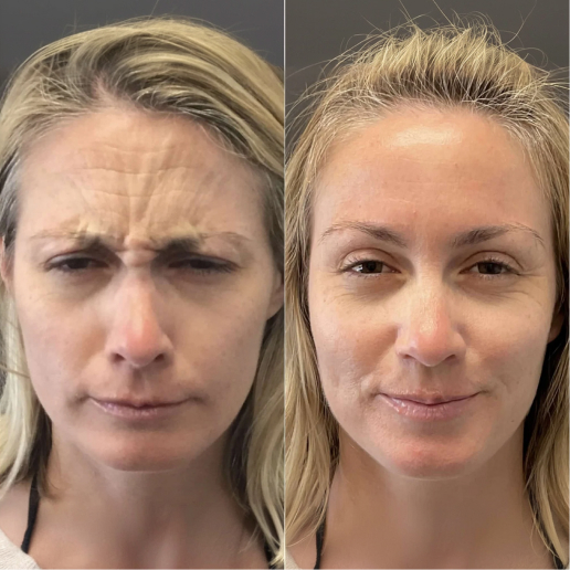 Botox Treatment