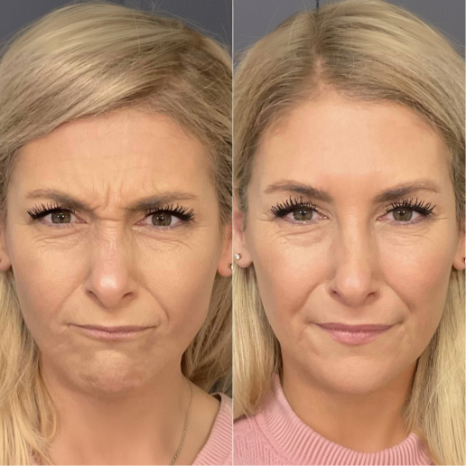 Botox Treatment