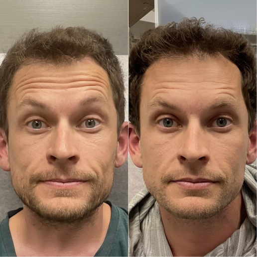 Botox Treatment