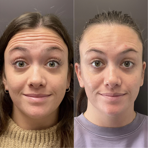 Botox Treatment